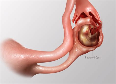 How Long Does Ruptured Ovarian Cyst Pain Last - LifeStyleAbout