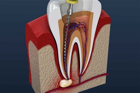 How Much Do Root Canals Cost? Pricing - Northmed Dental | North Shore Dentistry | Auckland