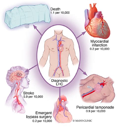 Safety and Risk of Major Complications With Diagnostic Cardiac ...