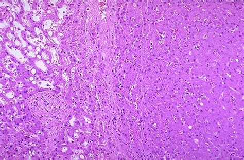 hepatic adenoma liver histology