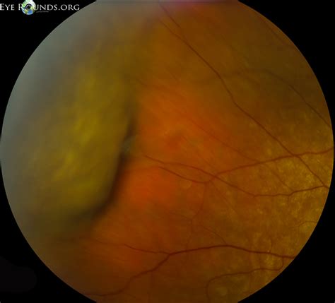 Atlas Entry - Choroidal Detachment: Hemorrhagic, Non-Appositional