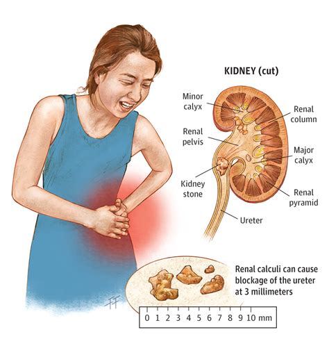 JAMA Pediatr. 2015;169(10):980. doi:10.1001/jamapediatrics.2014.2158. | Kidney stones, Kidney ...