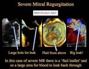 Leaky Heart Valve – When The Mitral Valve Fails