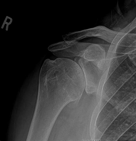 Glenohumeral Arthritis (Shoulder Arthritis) - Shoulder & Elbow - Orthobullets