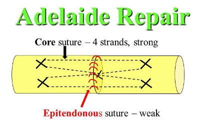 Flexor tendon injuries