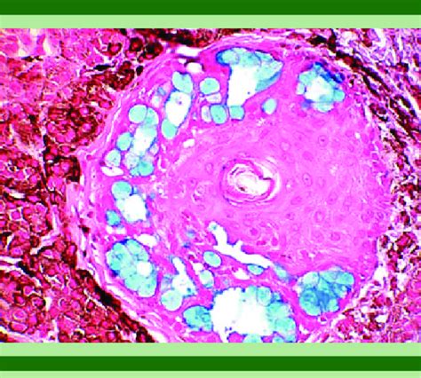 Hair follicle of a pilosebaceous unit harboring several minute mucinous... | Download Scientific ...