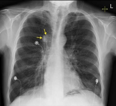 Lung cancer - CXR - Radiology at St. Vincent's University Hospital