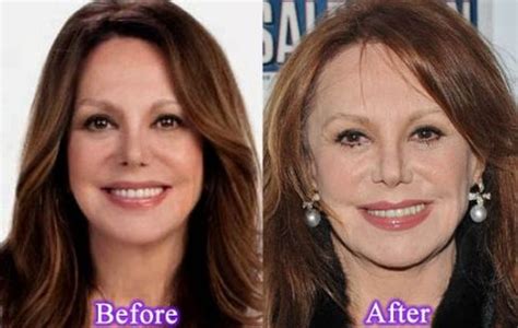 Marlo Thomas Before And After Plastic Surgery