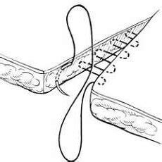 -Intradermal continious suture technique. | Download Scientific Diagram