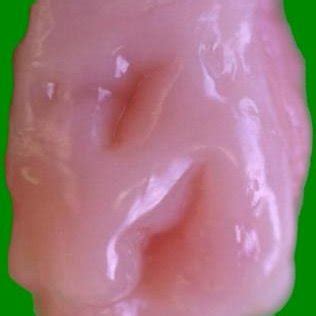 Histological section of the tubal tonsil showing primary and secondary ...