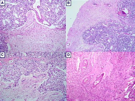 A, B and C: Microphotograph of histology of a patient with a recurrent... | Download Scientific ...