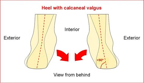 Pathologies > Calcaneal Valgus