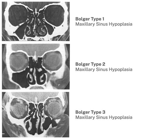 Bolger Classification of Maxillary Sinus Hypoplasia