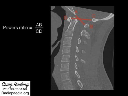 Atlanto Occipital Joint Xray