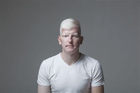 Symptoms and Causes of Oculocutaneous Albinism