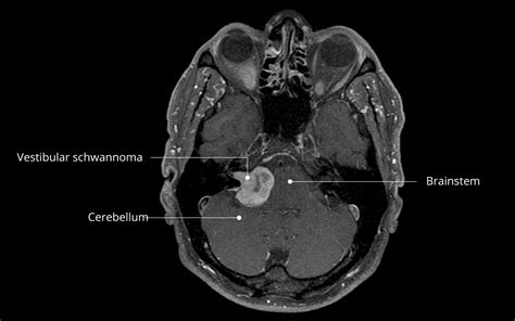 Vestibular schwannoma, acoustic neurinoma | Inselspital Bern