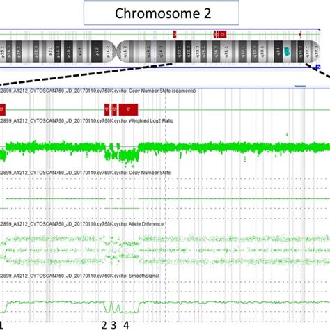 Result of the Affymetrix CytoScan 750 SNP array in patient 15: In the ...