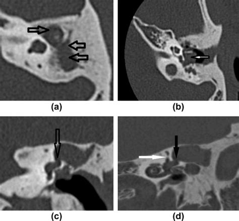 A 21year old male patient having cholesteatoma. Axial CT scan shows... | Download Scientific Diagram