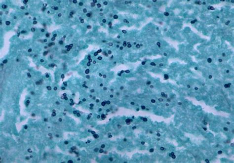 Histoplasmosis - GMS stain | Small yeast forms with many exh… | Flickr