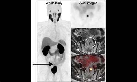 PSMA PET Scan for Prostate Cancer | UCSF Radiology