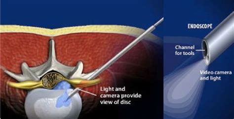 Endoscopic Spine Surgery | Dr. Paul Jeffords, MD