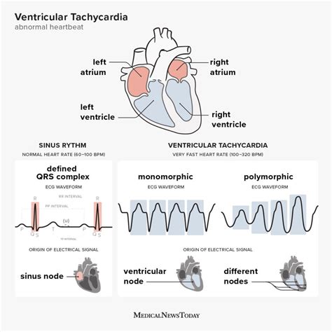 What is ventricular tachycardia? Types, symptoms, treatment