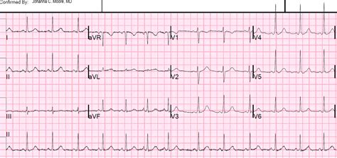 Image result for nsr 12 lead ecg