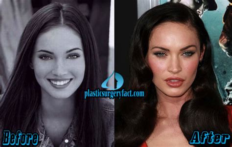 Megan Fox Plastic Surgery Before and After Photos