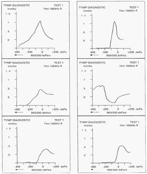 Tympanometry test, tympanometry types & abnormal tympanometry results