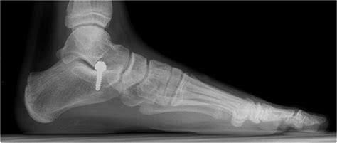 Flat feet surgery: when is it really needed? - Prof. Nicola Portinaro