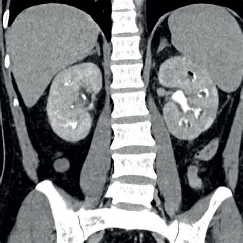 Renal papillary necrosis in the left kidney on delayed contrast CT scan... | Download Scientific ...