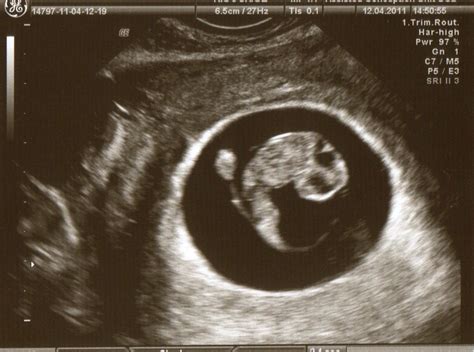 8 Week Pregnant Ultrasound 3d | www.imgkid.com - The Image Kid Has It!