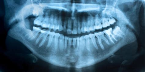 What are Supernumerary Teeth? (with pictures)