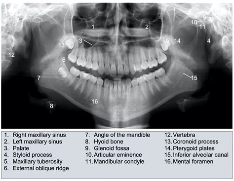 Mandibular Fractures | Anatomy, Management | Geeky Medics