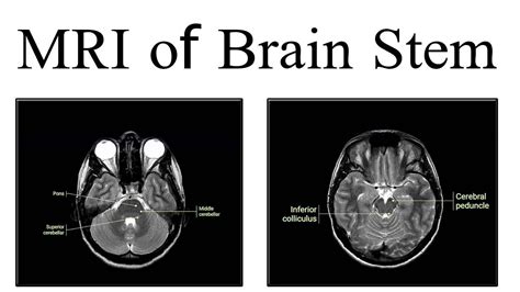 Inferior Colliculus Mri