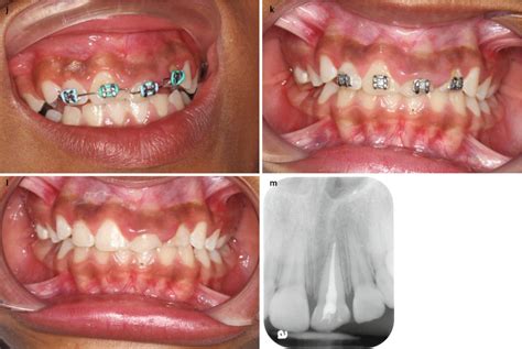 Pulp exposure apical vitality restorative pulpal necrosis dental pulp inflammation and necrosis ...