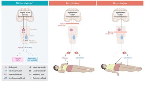 Abnormal Posturing Brain Injury