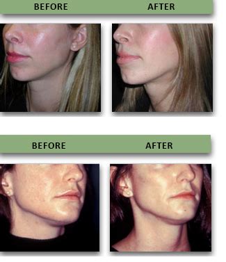 Malar (Cheek) Implants Boston | Cheek Lift or Midface Augmentation