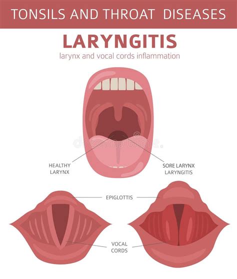 Laryngitis Symptoms Stock Illustrations – 86 Laryngitis Symptoms Stock Illustrations, Vectors ...