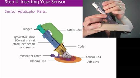 Dexcom Placement Areas