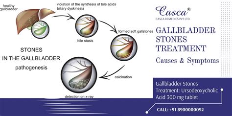 Gallbladder Stones Treatment, Causes, and Symptoms - Casca Remedies