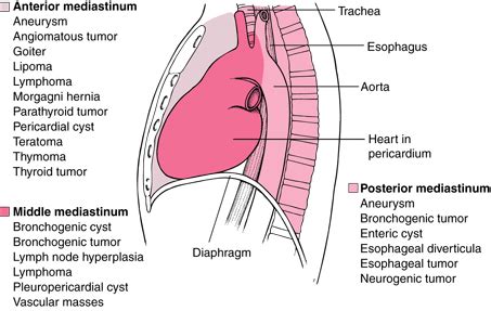 Mediastinal Tumors — Suncoast Surgical Associates