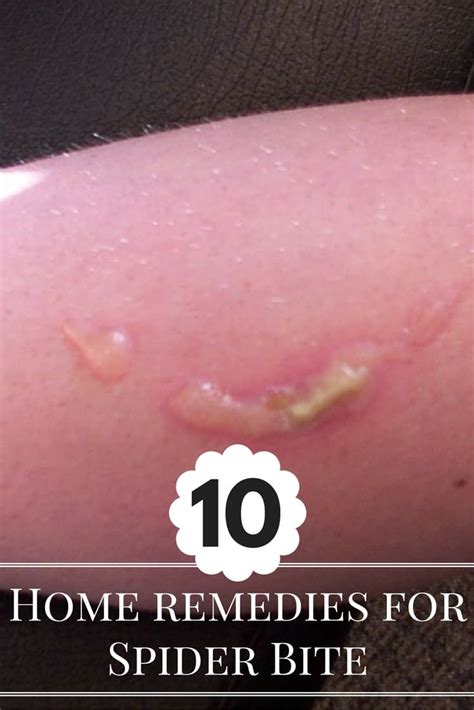 10 Natural Home Remedies for Spider Bite Treatment