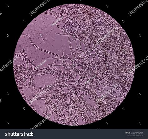 Microscopic Fungi Malassezia Furfur Showing Yeast Stock Photo ...