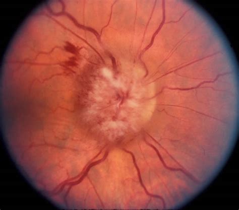 Papilledema causes, symptoms, grades, stages & papilledema treatment