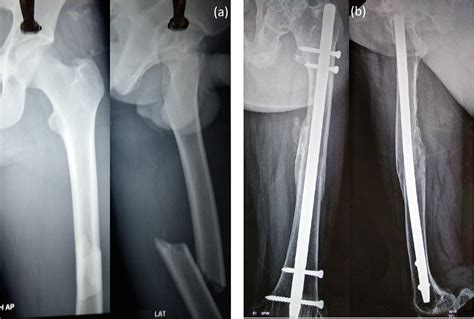 Intramedullary Nail Femur Recovery Time - Nail Ftempo