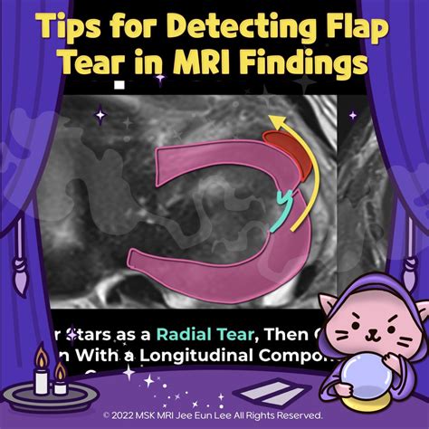 (Fig 1-B.16) Tips for detecting flap tear in MRI findings
