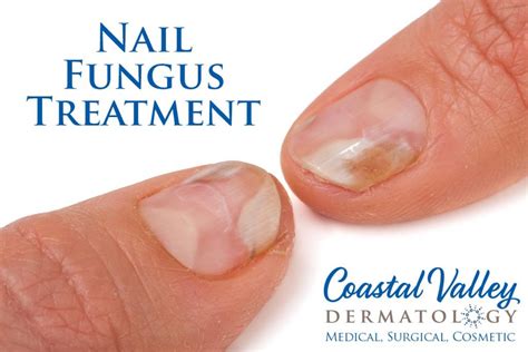 Nail Fungus - Coastal Valley Dermatology