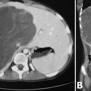 Computed tomography images of a hypodense lesion in the right lobe of... | Download Scientific ...