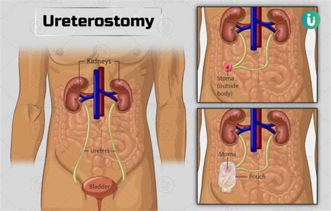 Ureterostomy: Procedure, Purpose, Results, Cost, Price